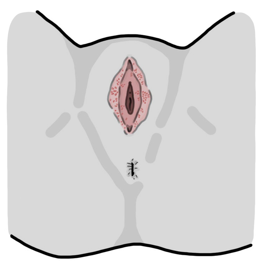 Pearly papules in the vulva