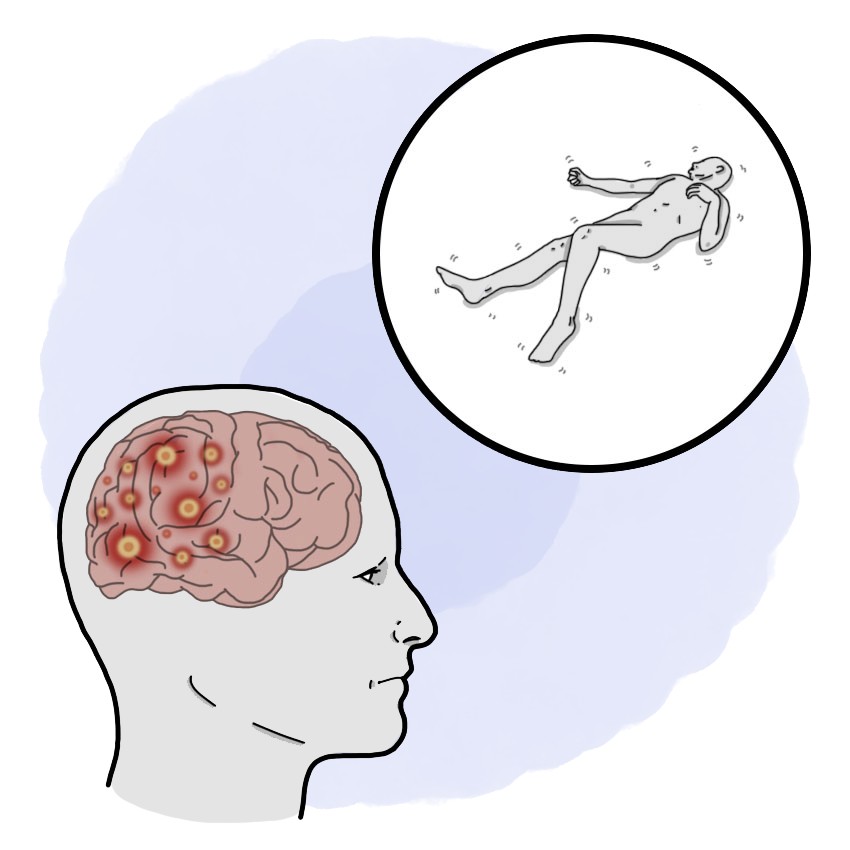 Epilepsy - Tonic-clonic seizures