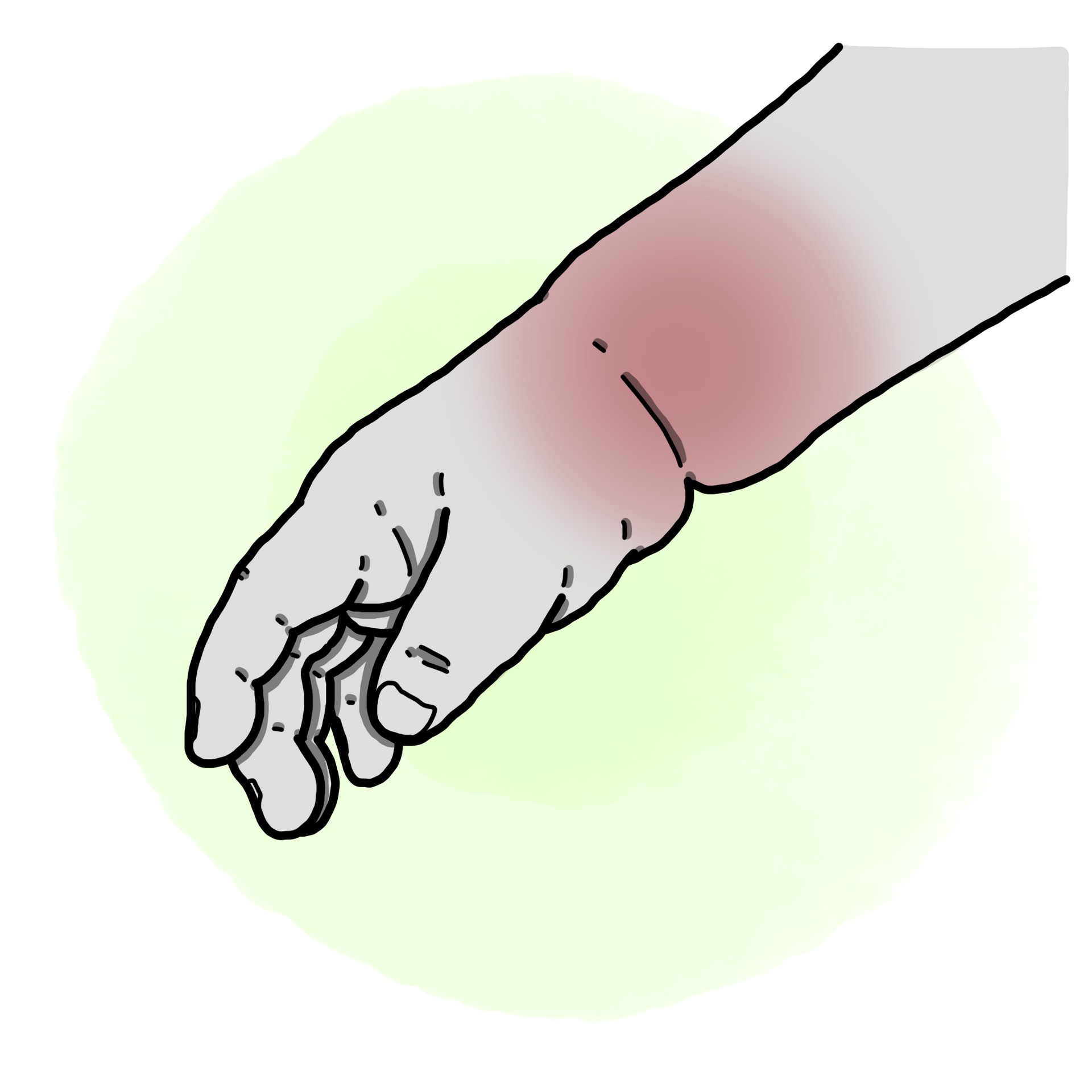 Paediatric Sprained Wrist (Paediatrics)