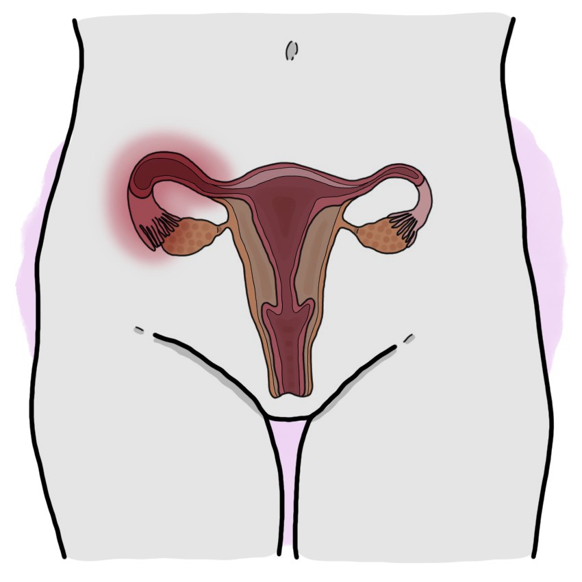 Pelvic inflammatory disease