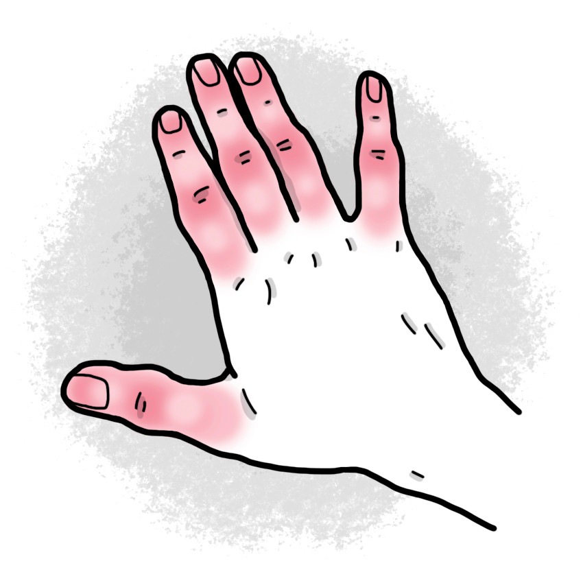 Second-degree superficial frostbite