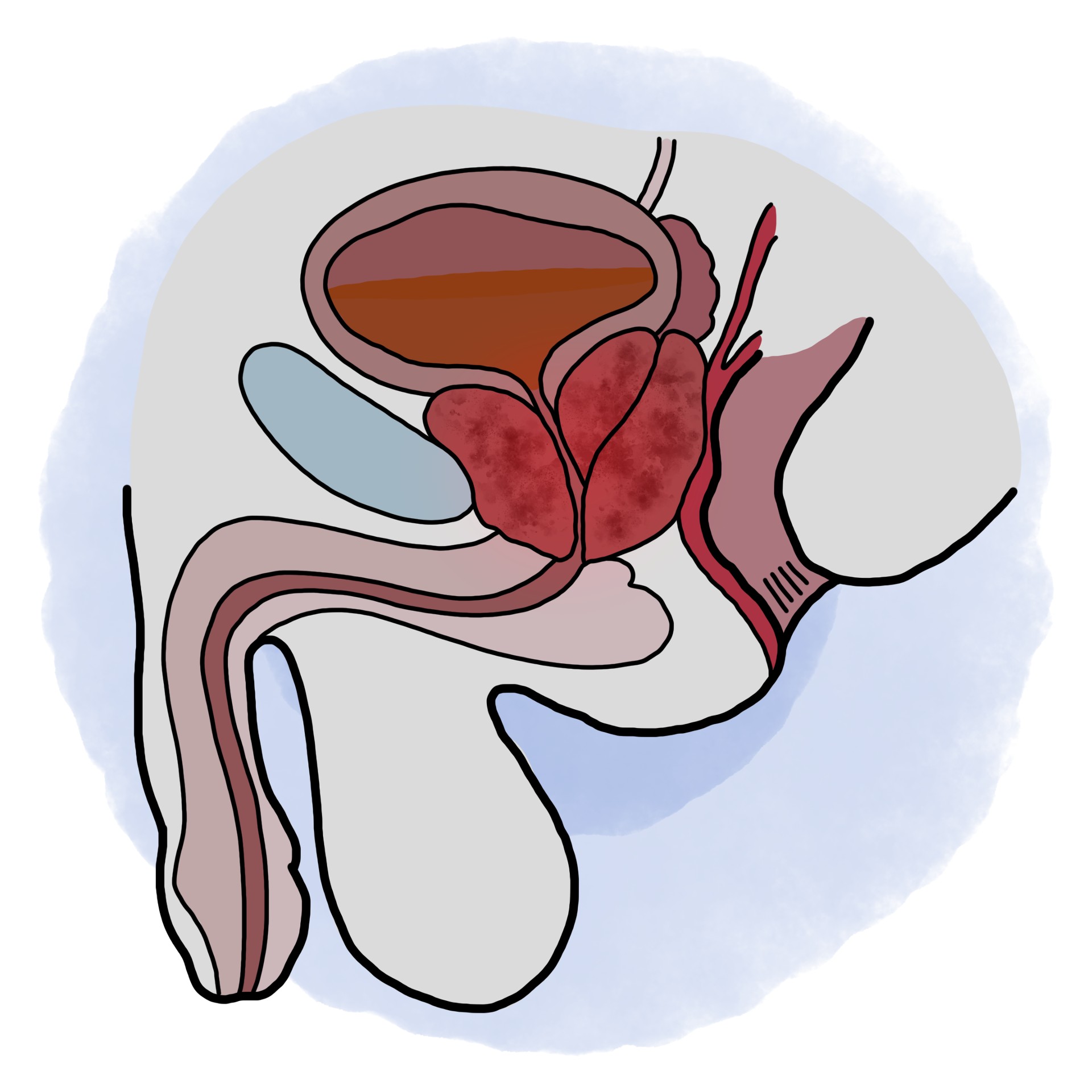 Benign prostatic hyperplasia
