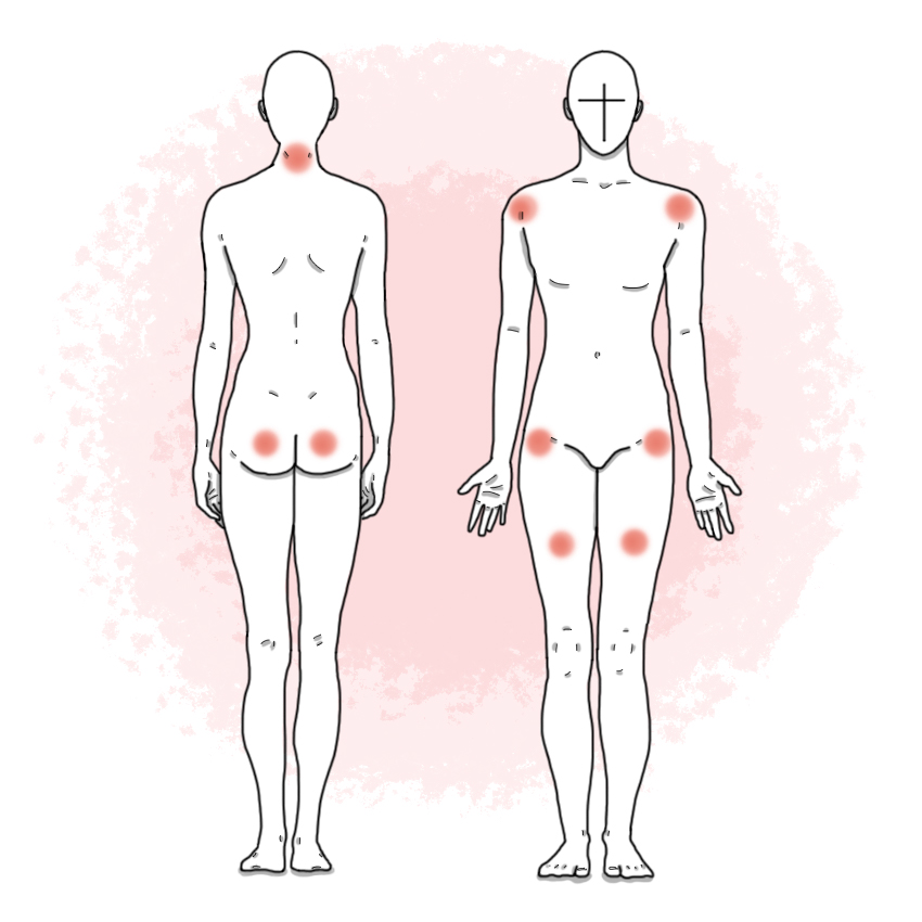 Polymyalgia rheumatica