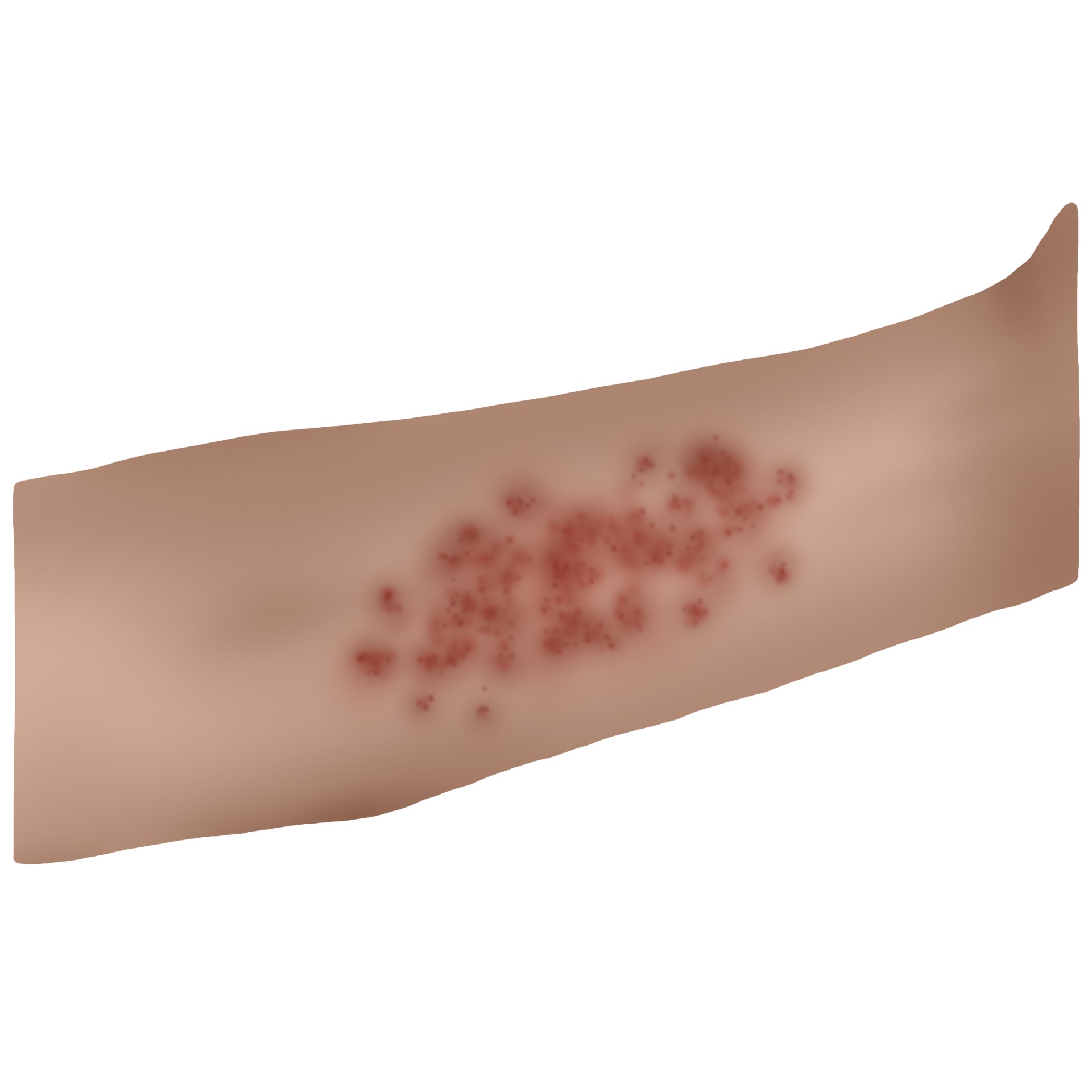 Scabies (Paediatrics)