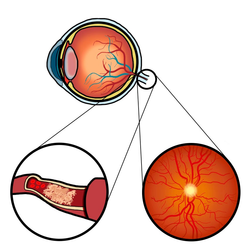 Central retinal artery occlusion