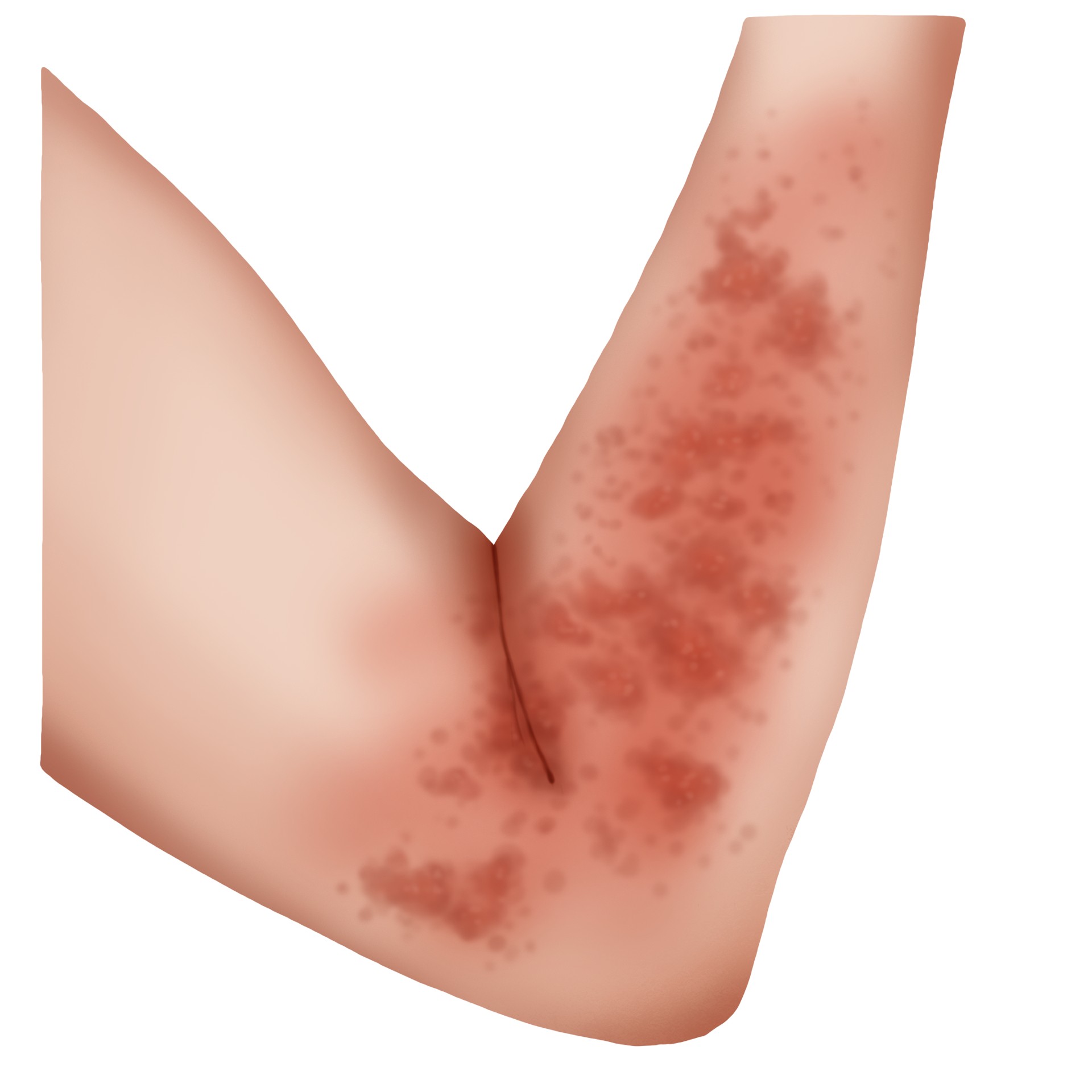 Uncomplicated skin allergy