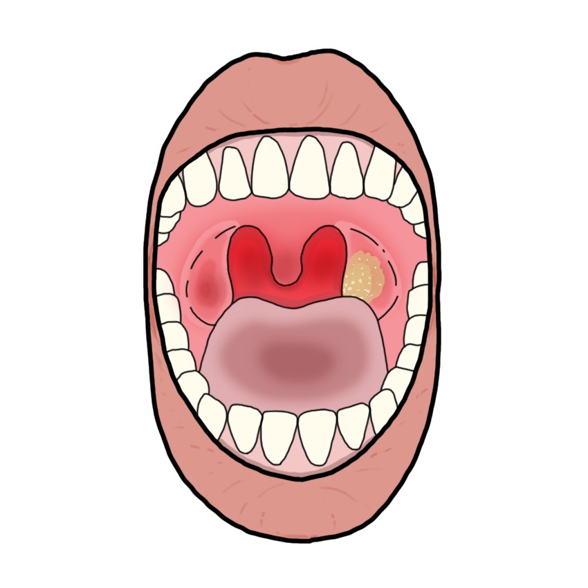 Tonsillopharyngitis due to diphtheria