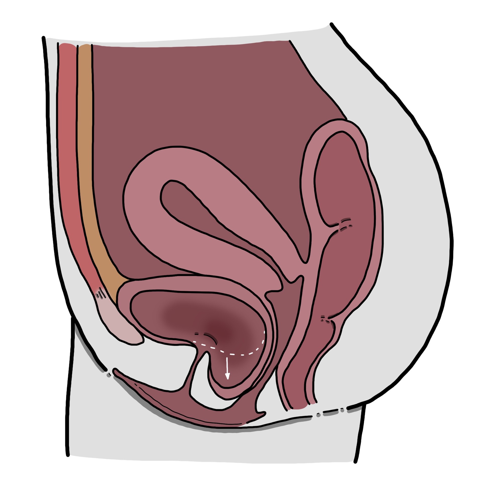 Prolasso della vescica - Cistocele