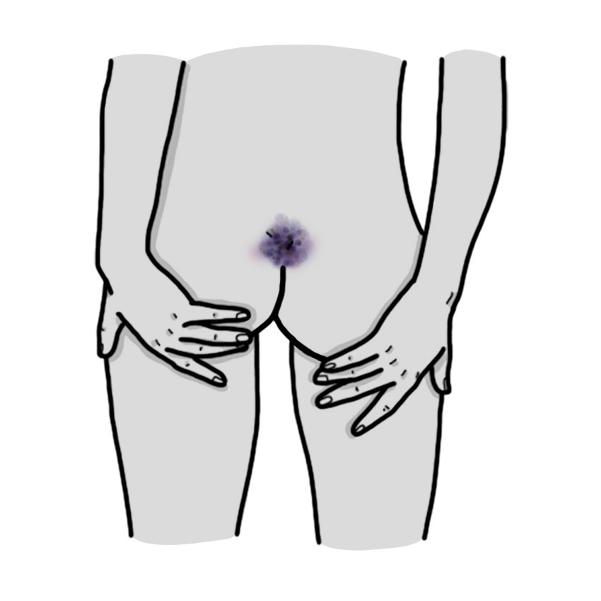 Hematoma en coxis