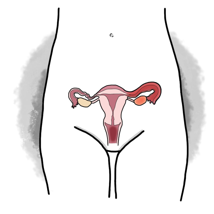 Inflammation of the fallopian tubes - Salpingitis