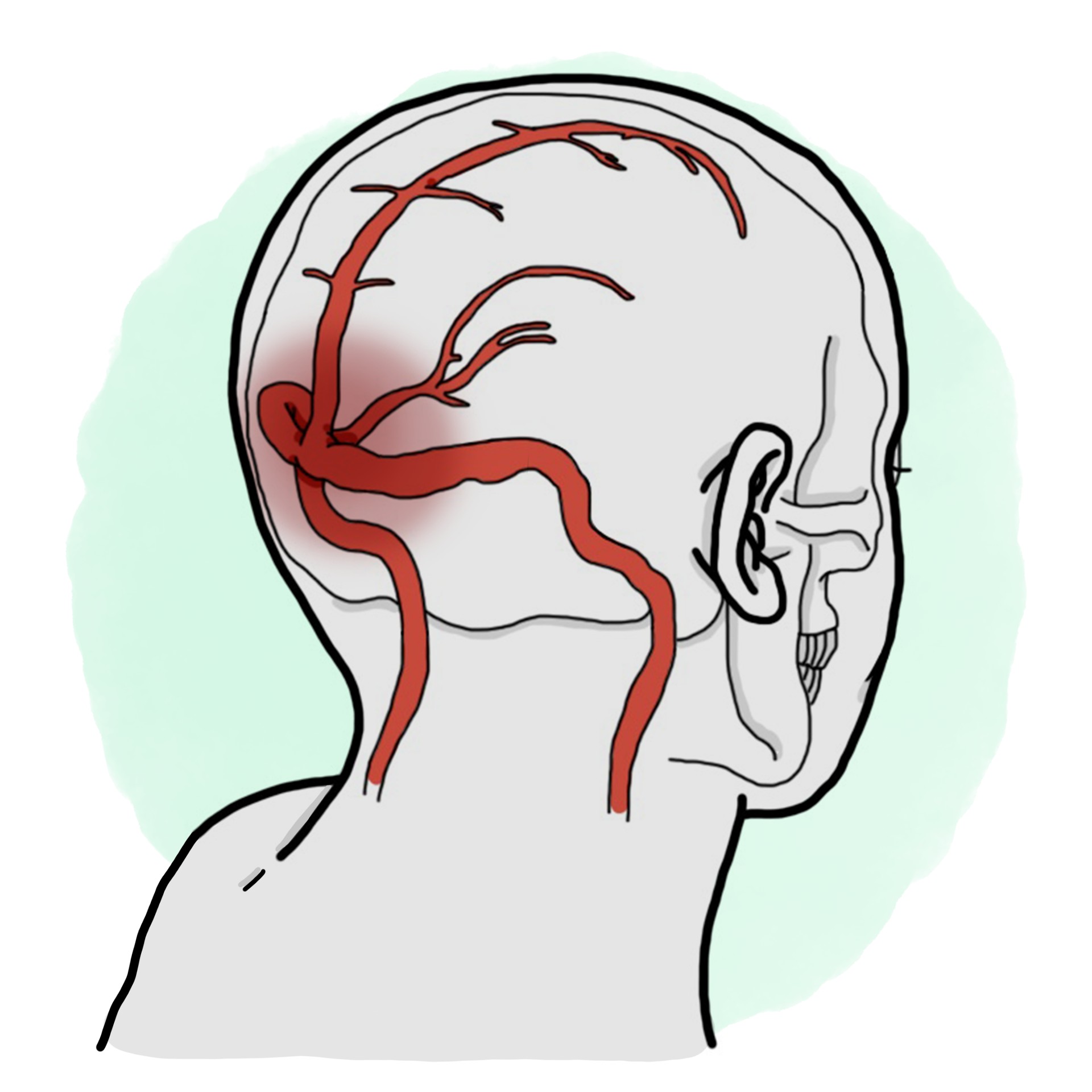 Venous sinus thrombosis - Cerebral venous sinus thrombosis