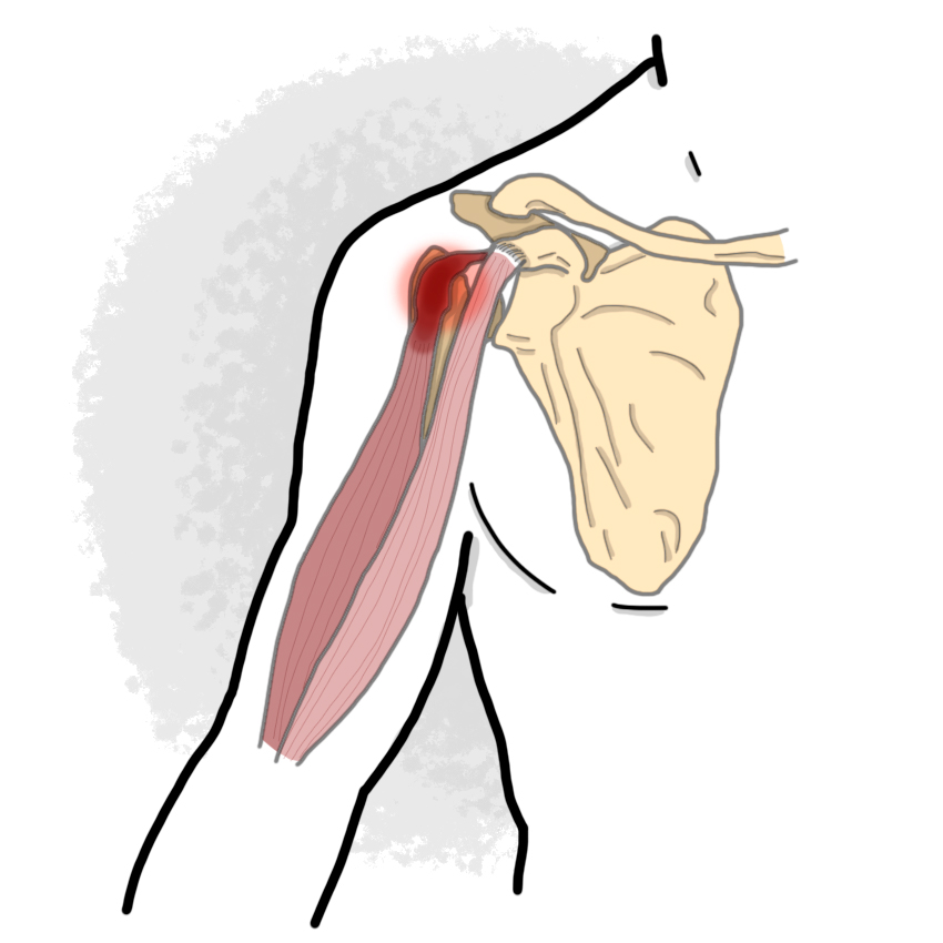 Painful shoulder of musculotendinous origin - Bicipital tendinitis