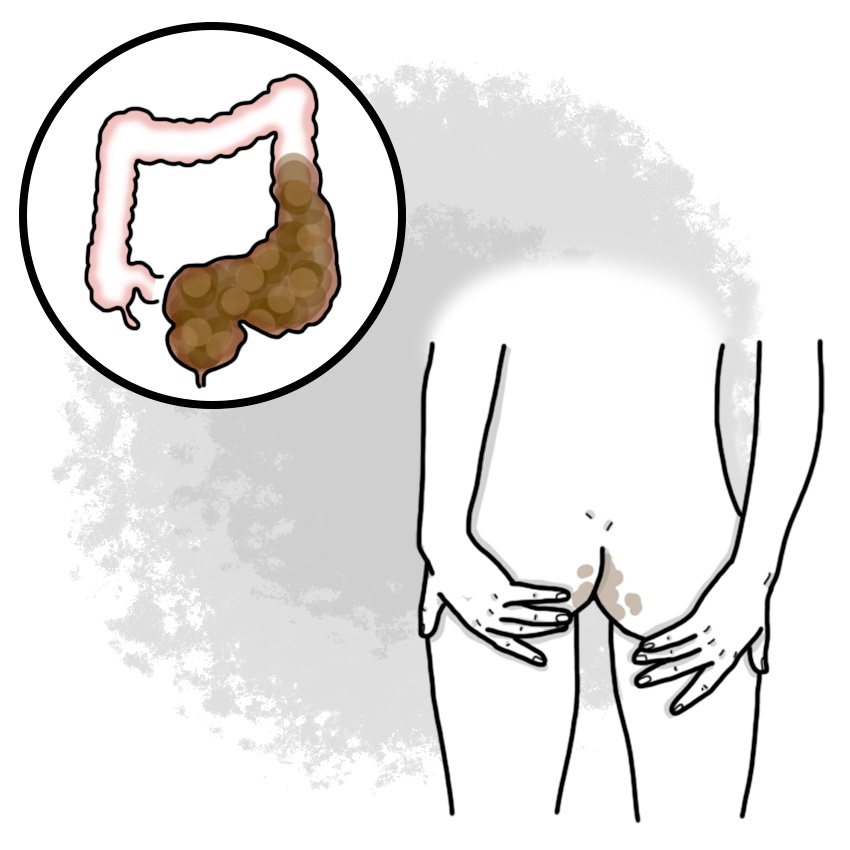Stool incontinence - Encopresis (Paediatrics)