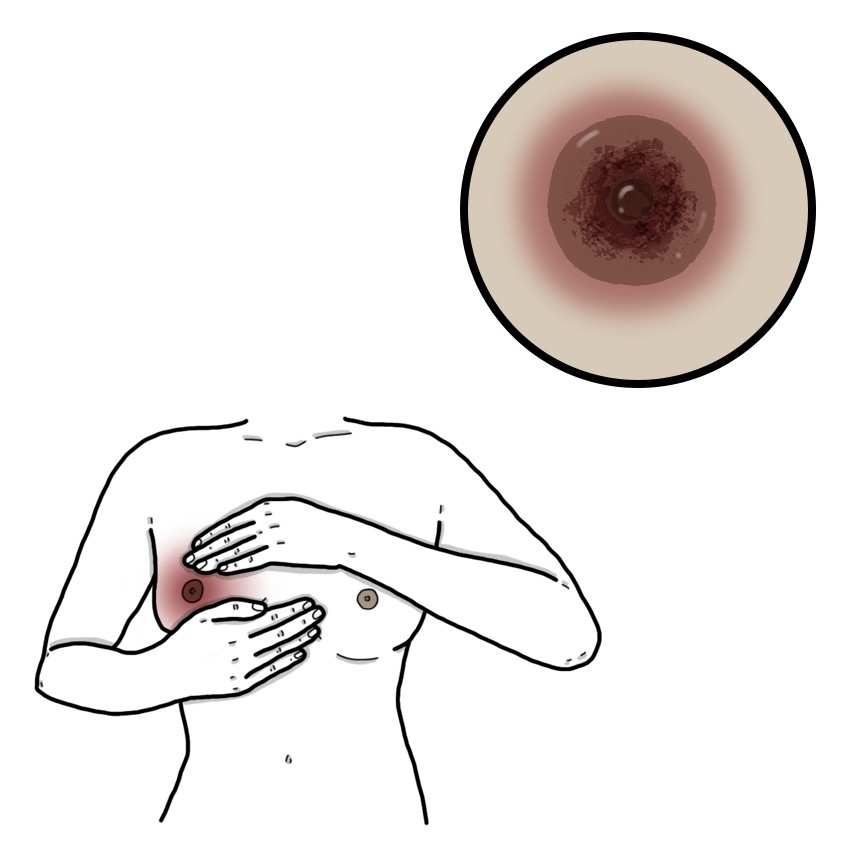 Nipple thrush - Nipple candidiasis