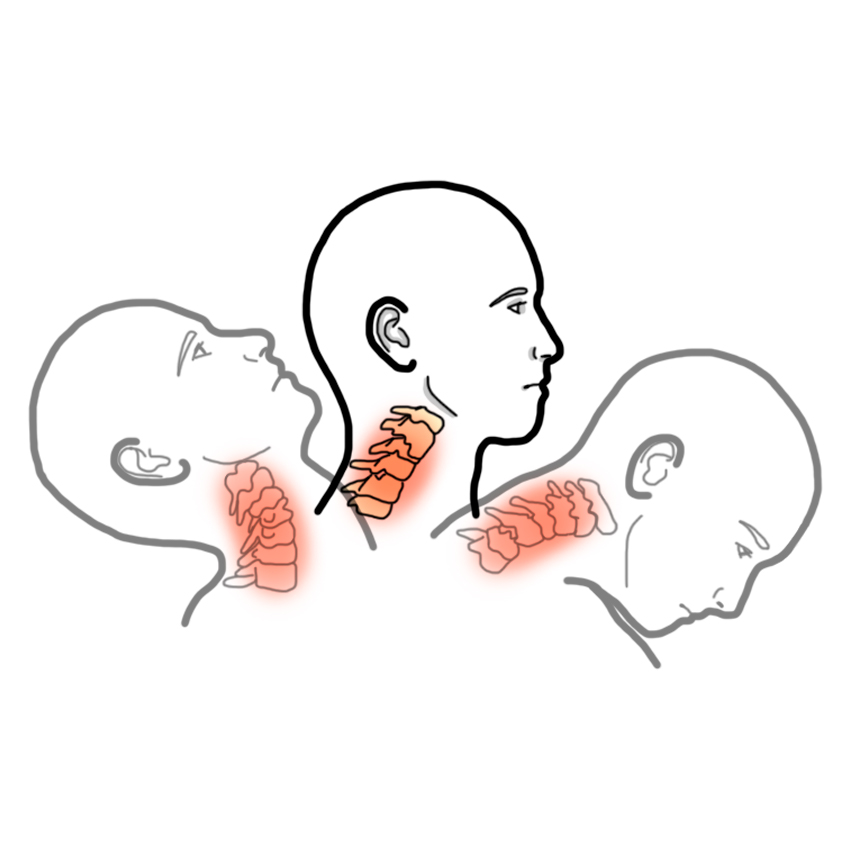 Cervical whiplash - Sprained spine ligaments