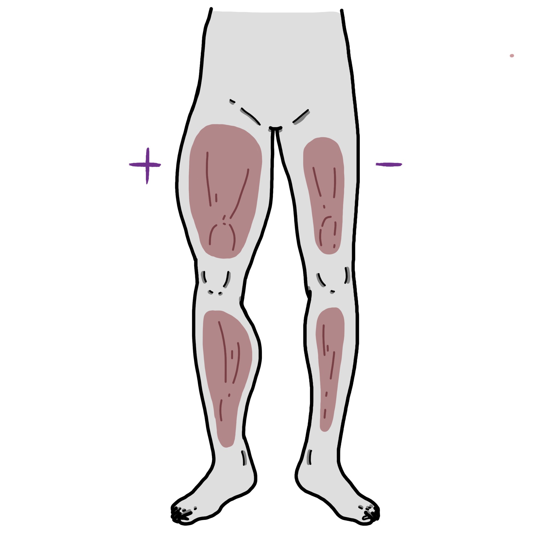 Atròfia muscular a una cama