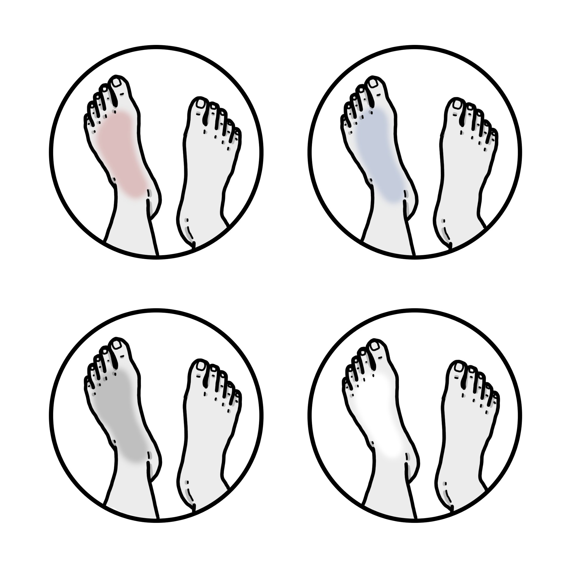 Colour change of the foot