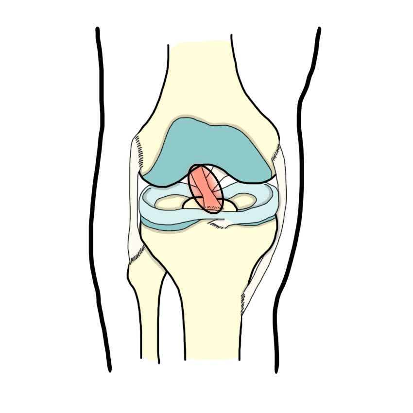 Anterior cruciate ligament (ACL) injury