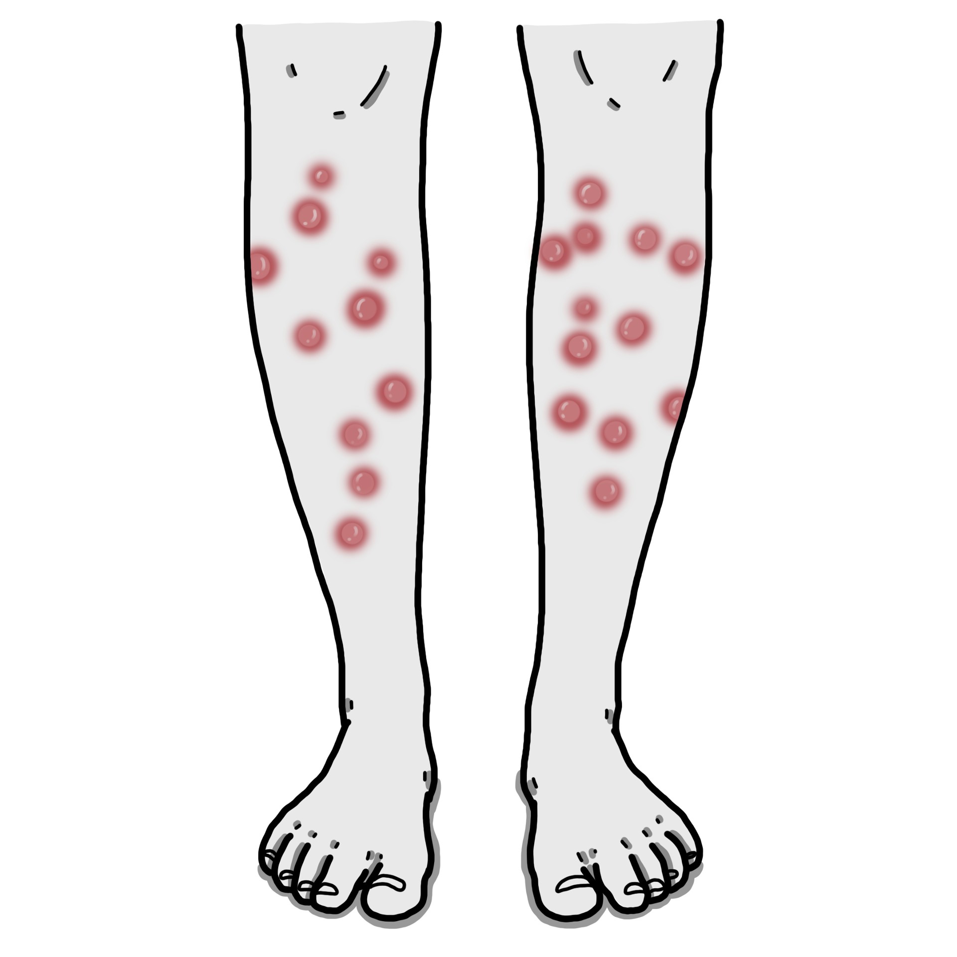 Nodules avec la peau chaude