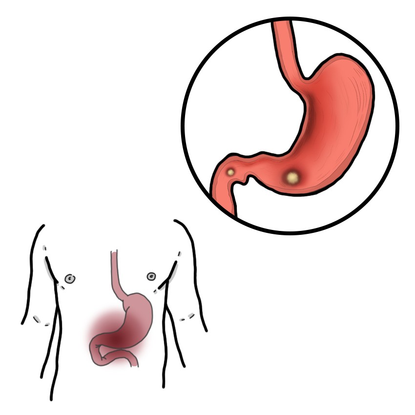 Gastric and/or duodenal ulcer