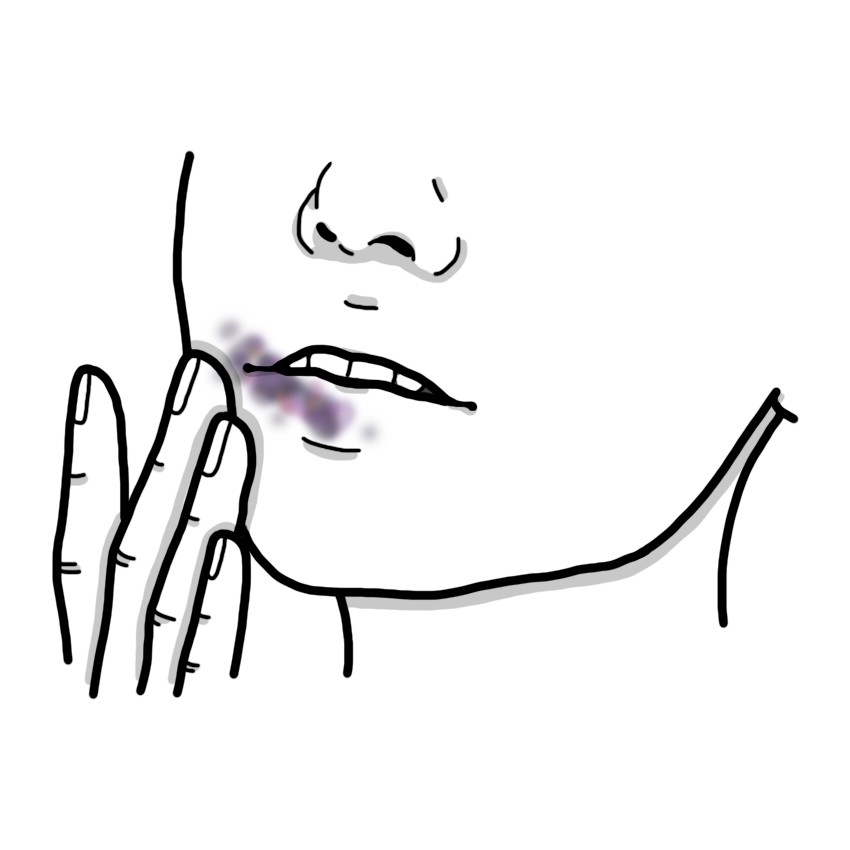 Mouth trauma - Oral contusion