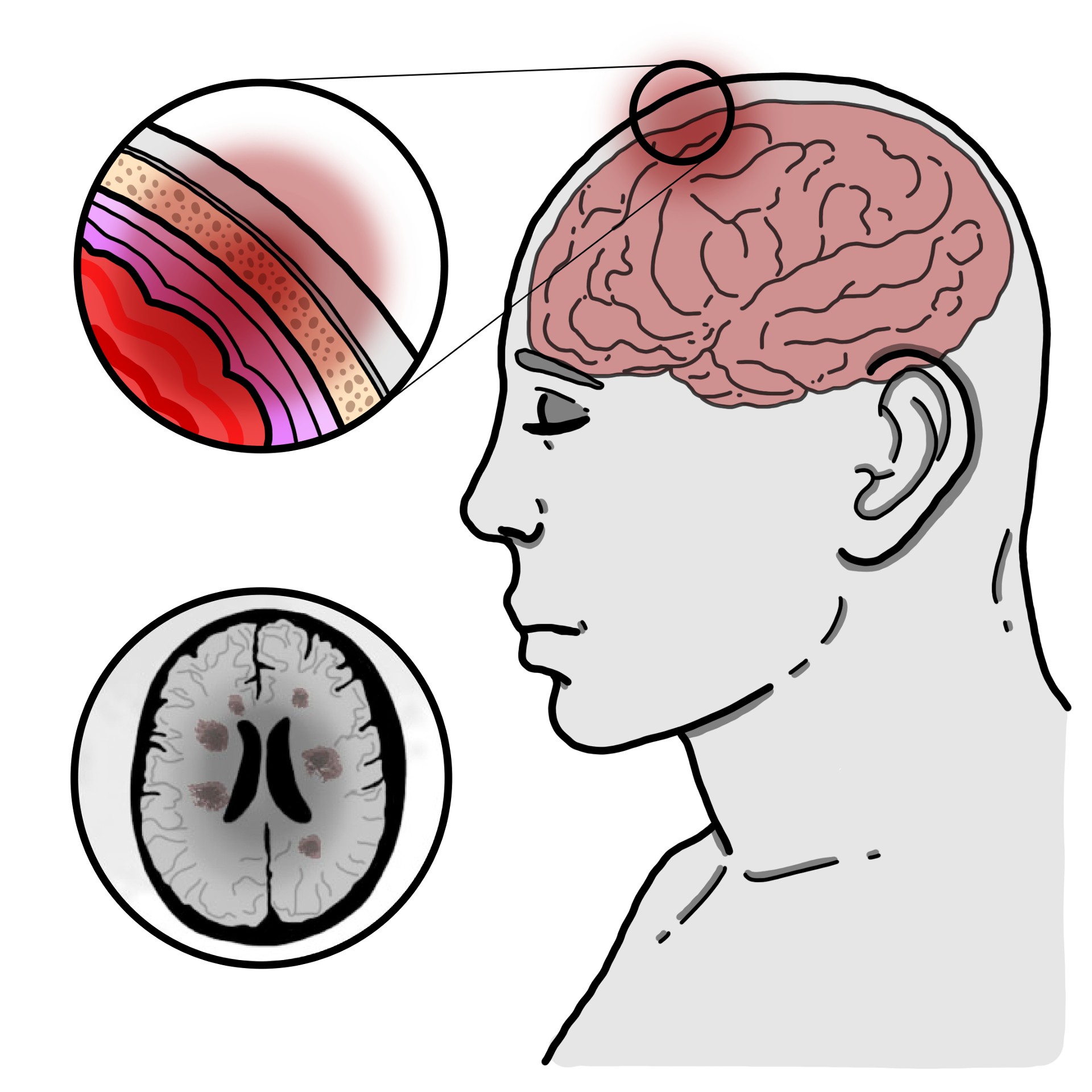 Tuberculous meningitis