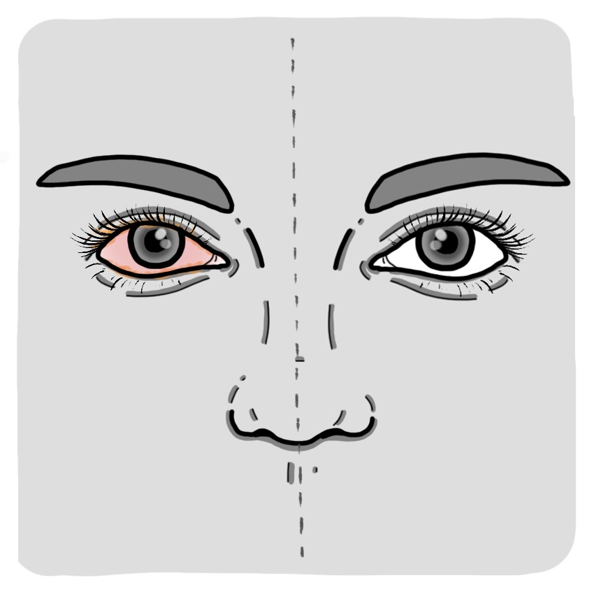 Bacterial conjunctivitis