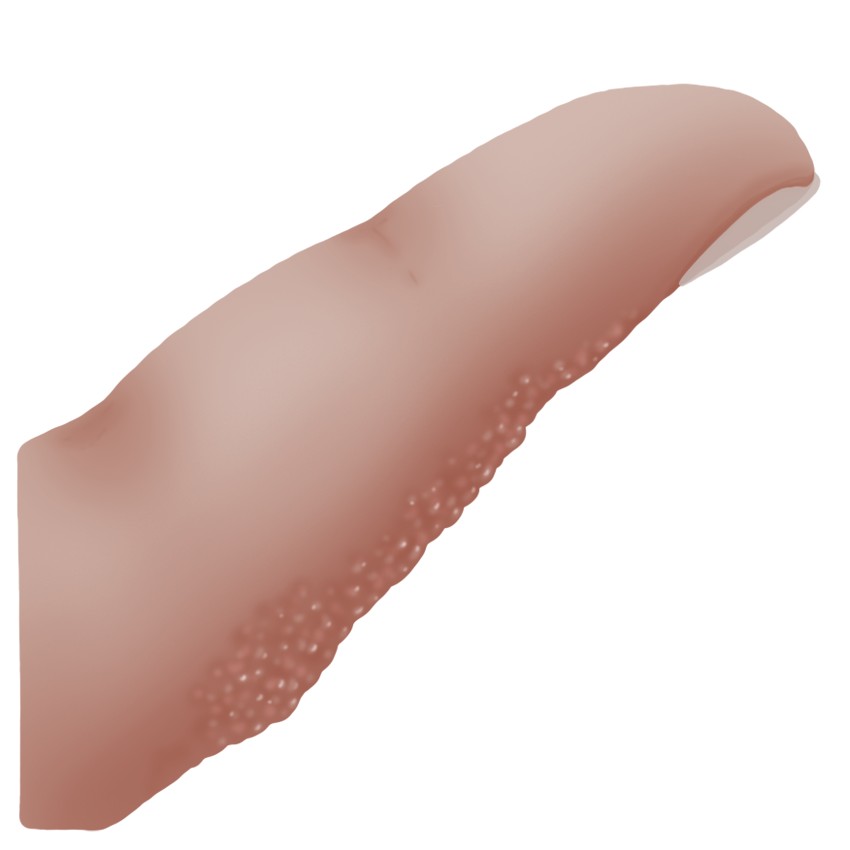 Dyshidrotic eczema - Pompholyx