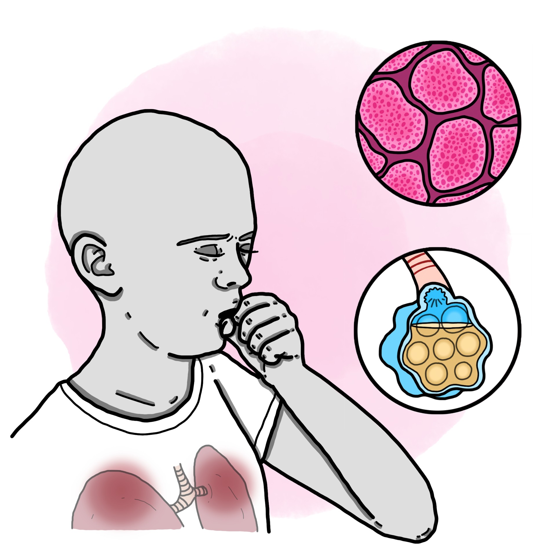 Atypical pneumonia (Paediatrics)