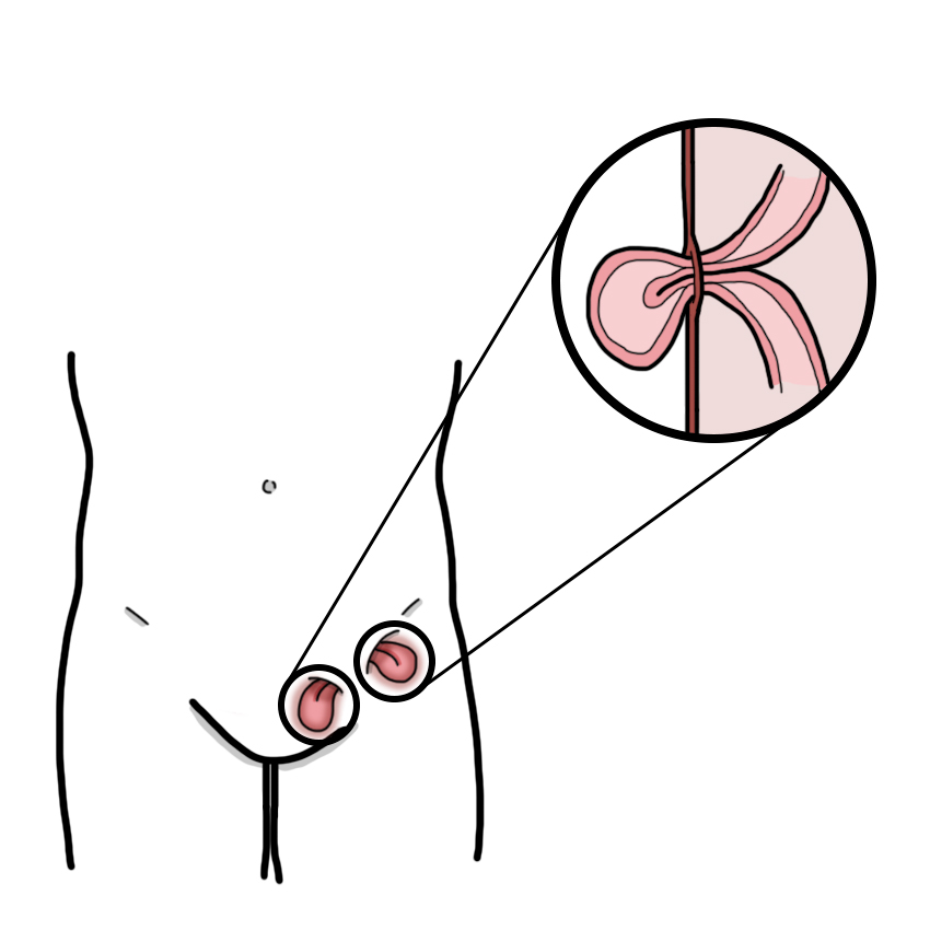 Irreducible inguinal or femoral hernia