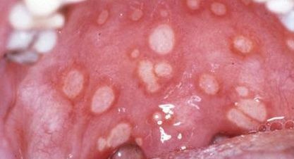 Síndrome de Behçet (Pediatría)