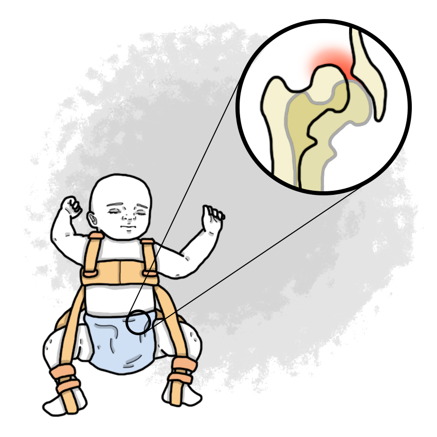 Congenital luxation or dysplasia of the hips (Paediatrics)