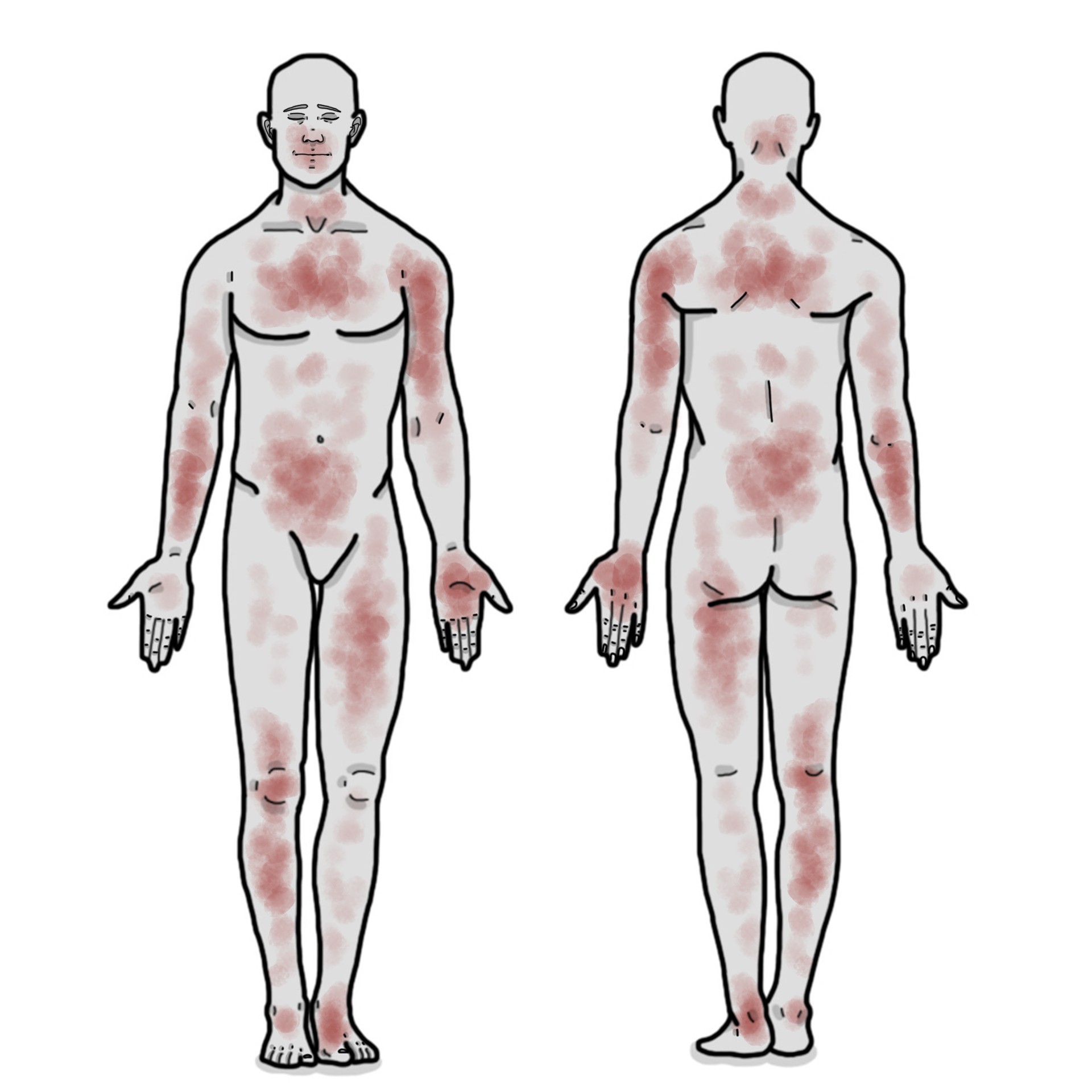 Éruption cutanée sur tout le corps