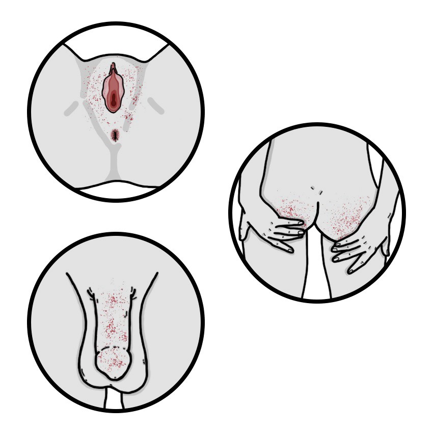 Περιοχή γεννητικών οργάνων ή/και γλουτοί με μικρά σπυράκια