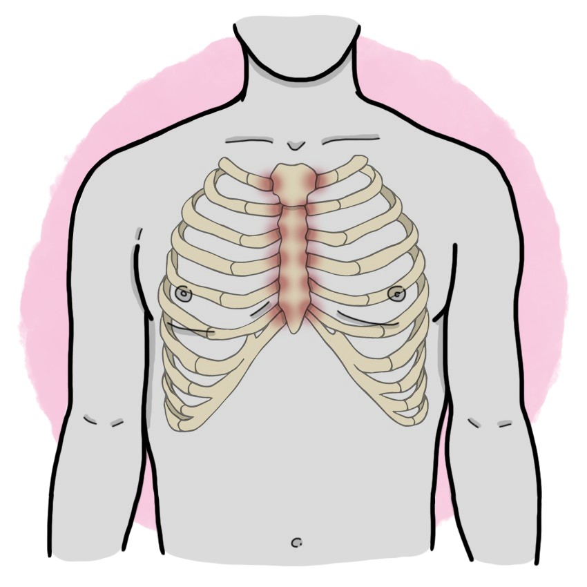 Costochondritis - Tietze's syndrome