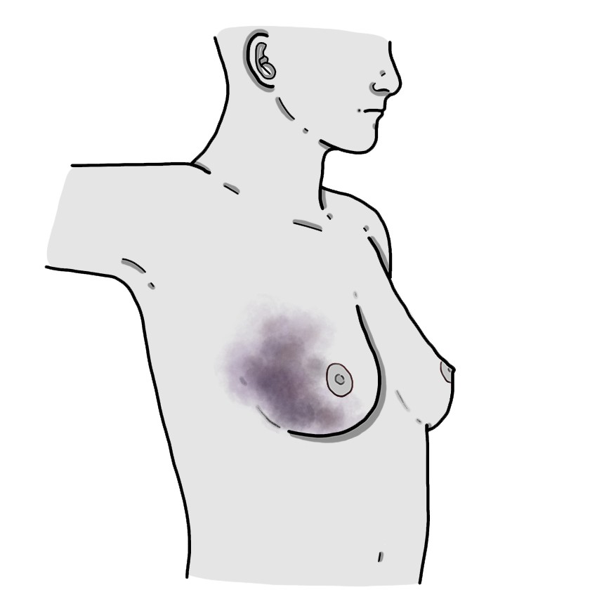 Hematoma en la mama