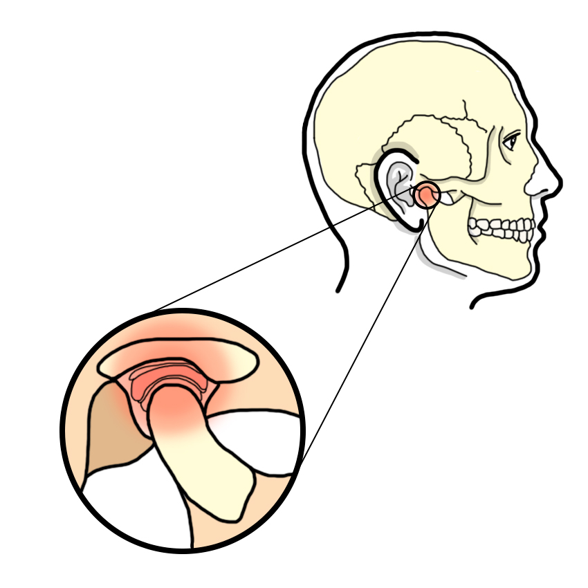 Temporomandibular joint disorder
