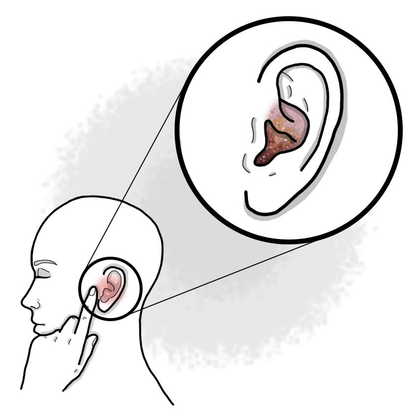 Herpes zoster of the ear - Herpes zoster oticus - Ramsay-Hunt syndrome
