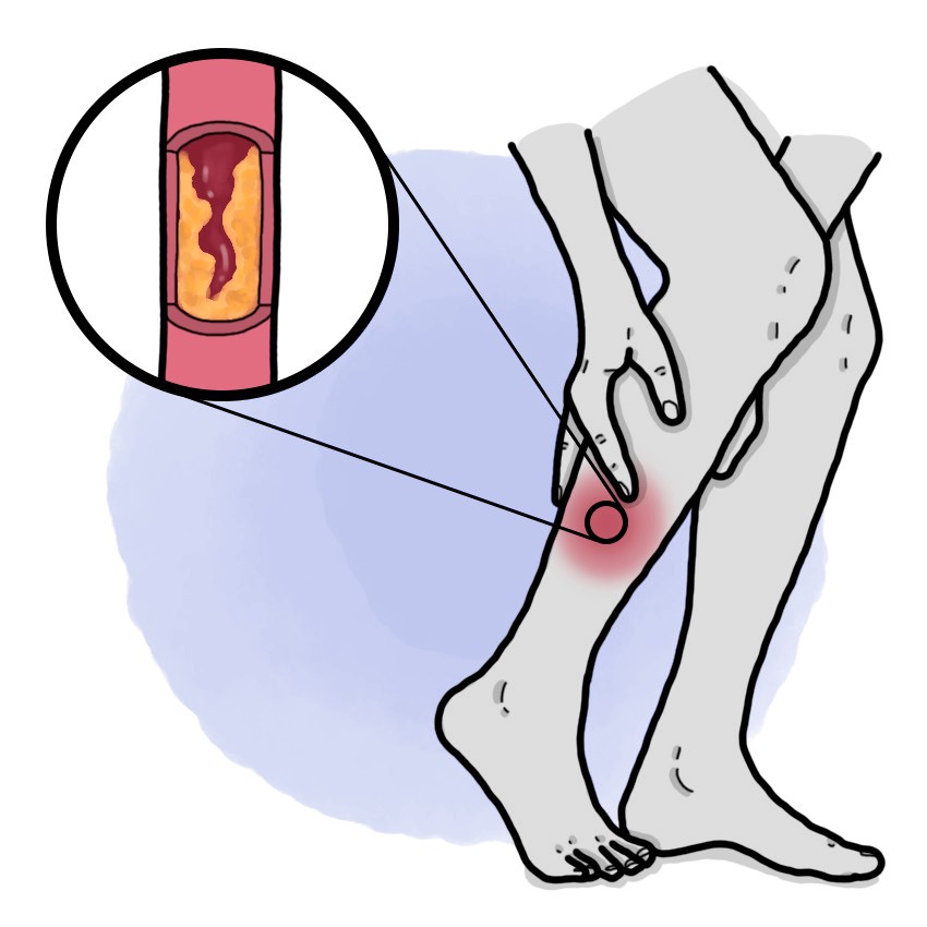 Peripheral arterial disease