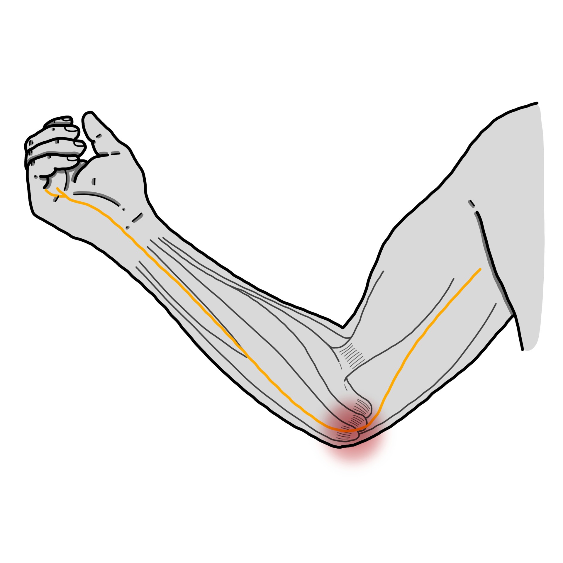 Cubital tunnel syndrome