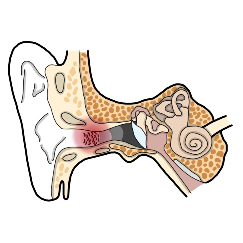 Otitis externa (Paediatrics)