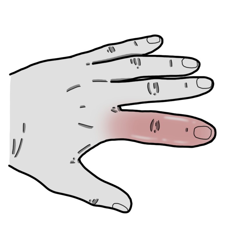 Finger inflammation