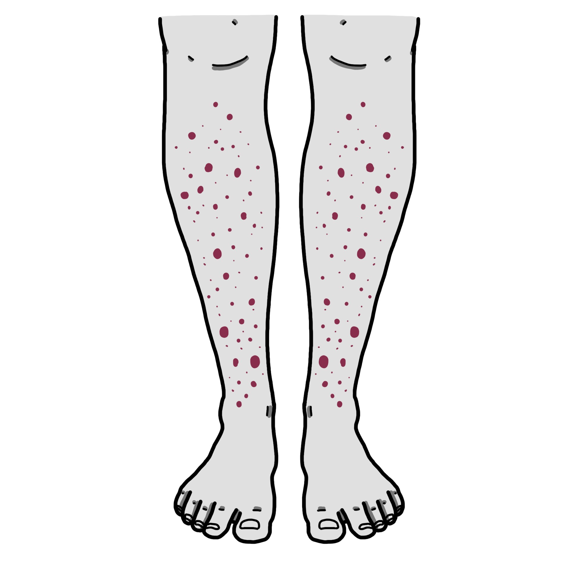 Henoch-Schönlein Purpura - IgA vasculitis (Paediatrics)