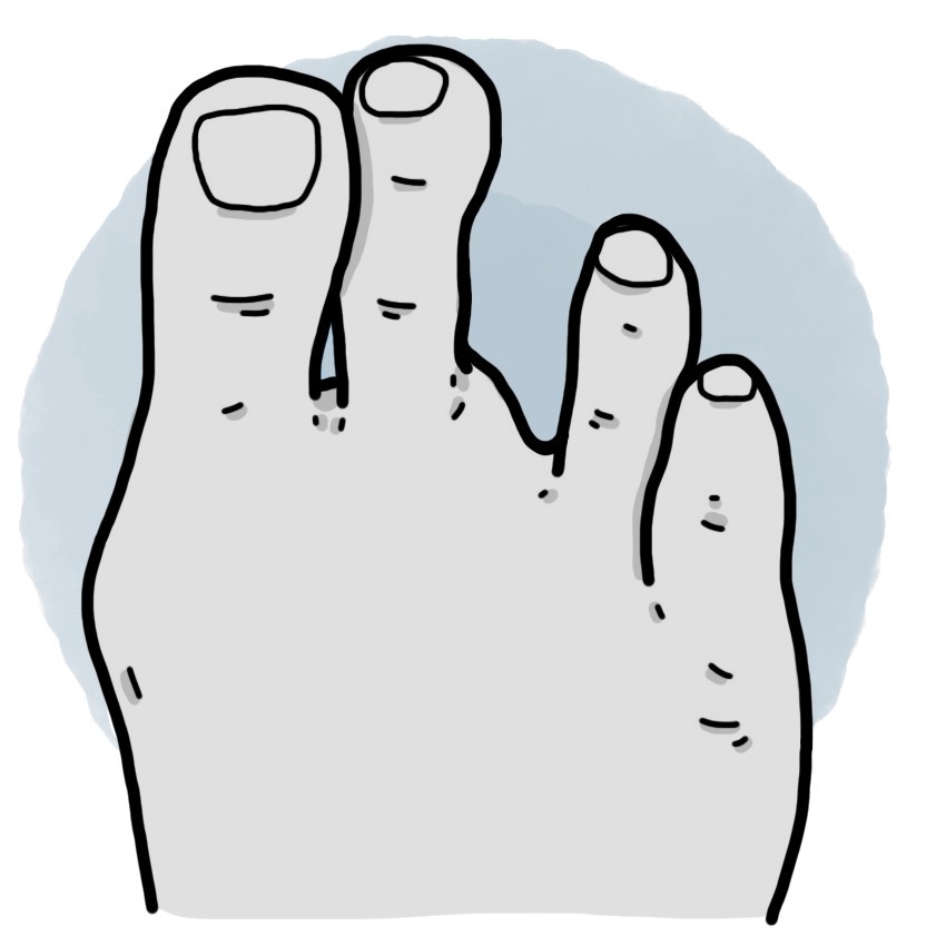 Third toe amputation