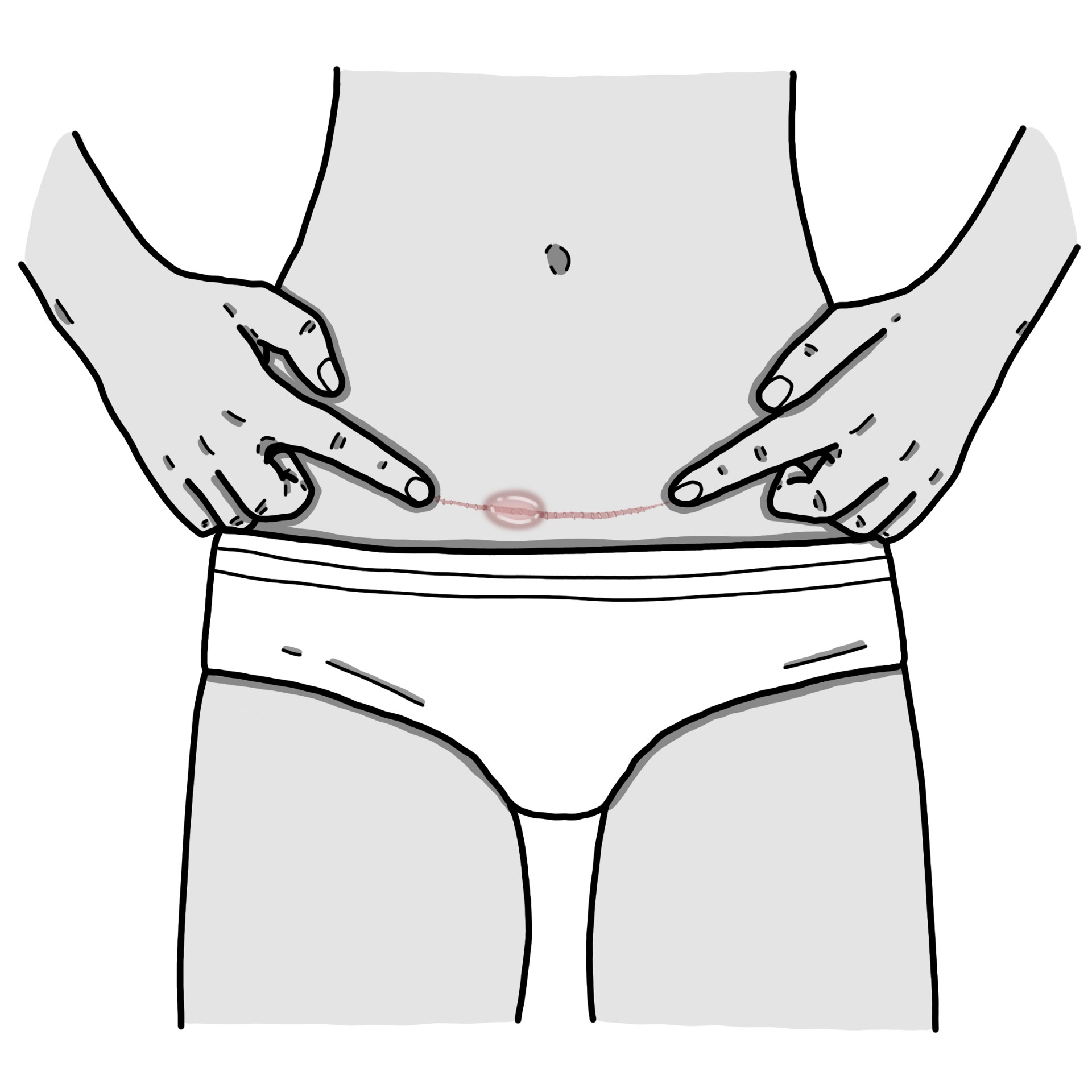 Caesarian wound seroma