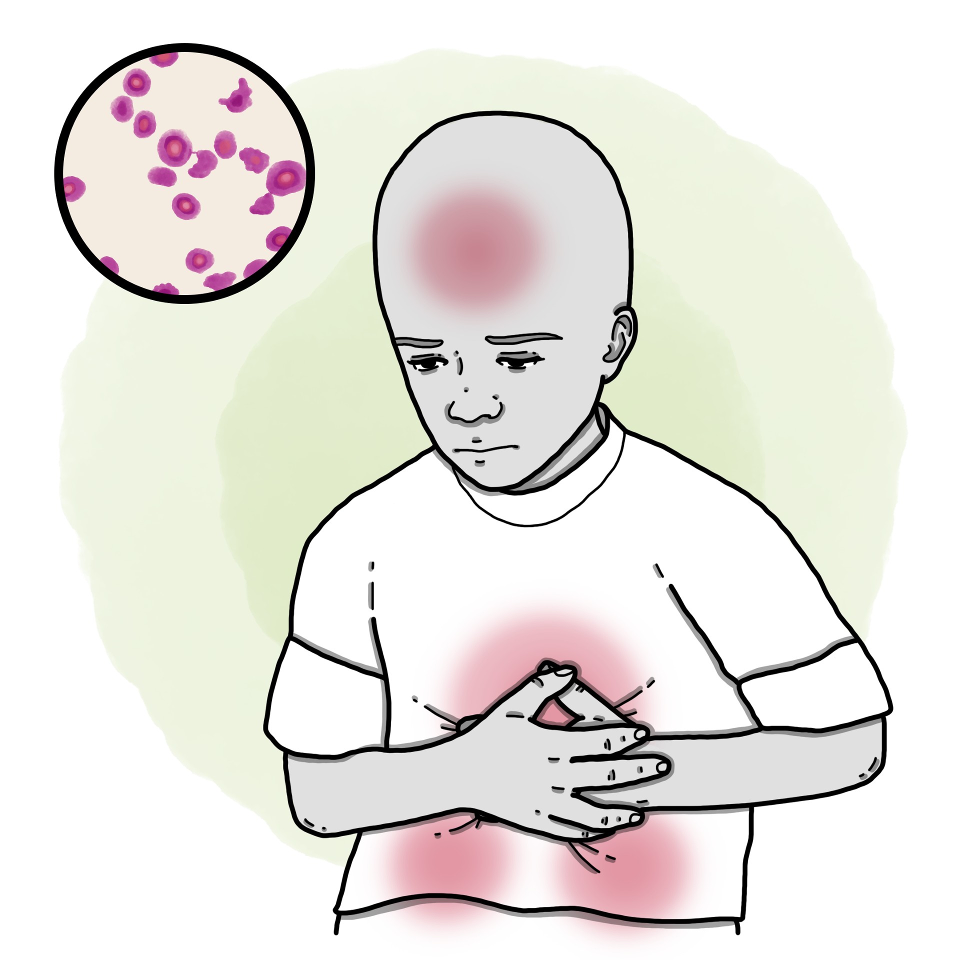 Haemolytic-uraemic syndrome - HUS (Paediatrics)
