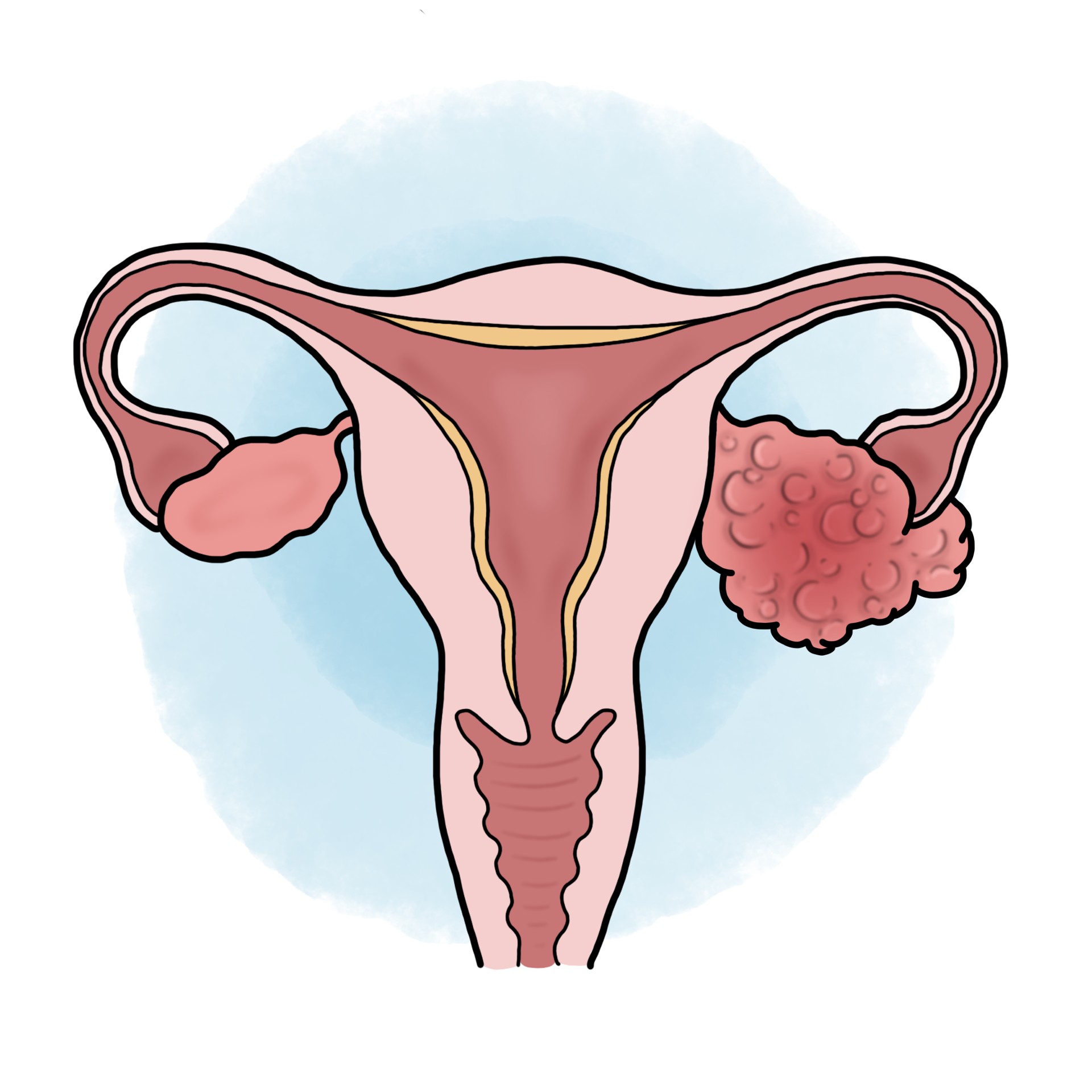 Ovarian cancer