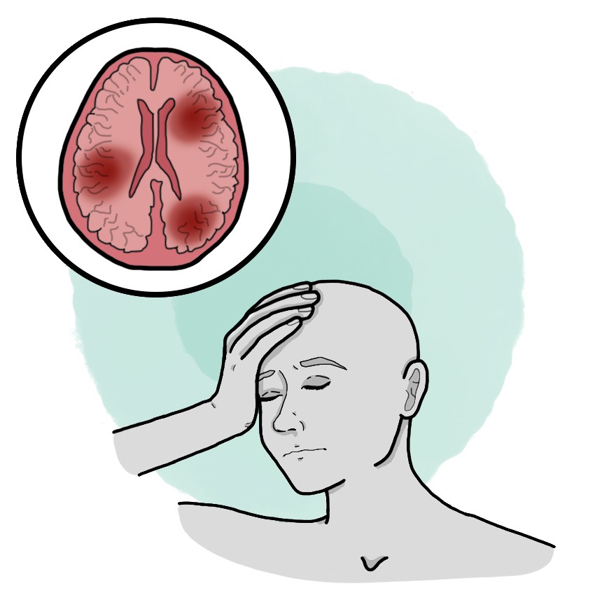 Vascular dementia - Multi-infarct dementia