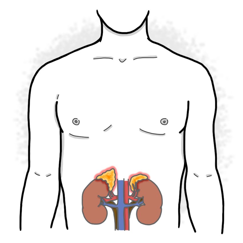 Adrenal insufficiency - Addison's syndrome, autoimmune adrenalitis, exogenous administration of corticosteroids, etc.