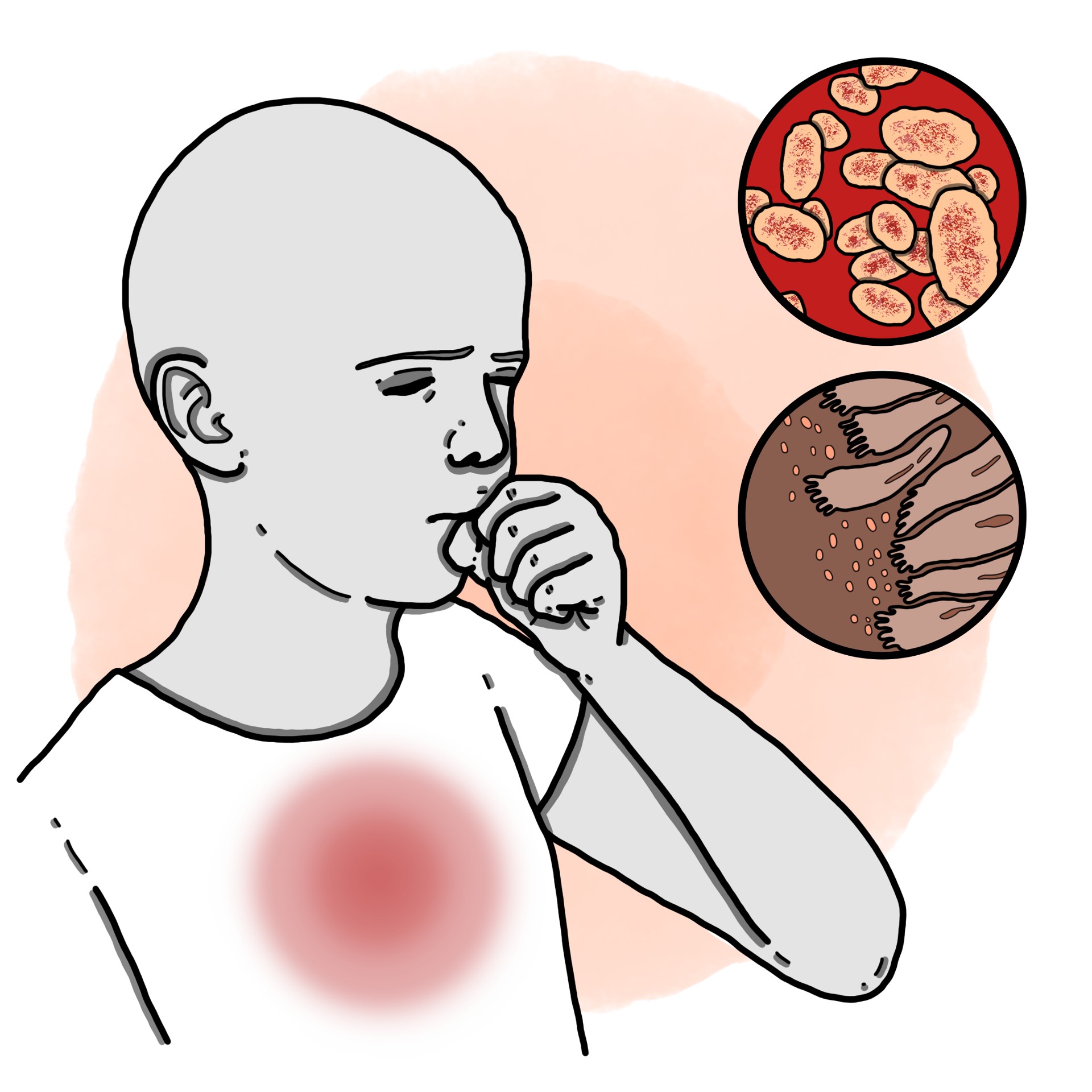 Whooping cough (Paediatrics)
